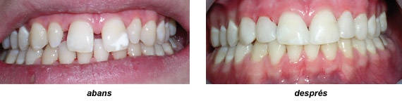 Imatge carilles composite tractament exemple 1