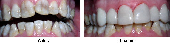 Imagen carillas composite tratamiento ejemplo 2