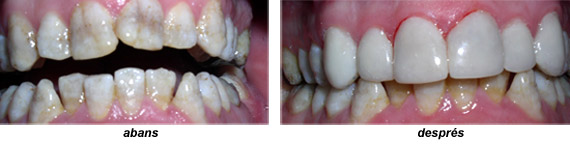 Imatge carilles composite tractament exemple 2