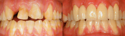 Imatge de ponts en pròtesis dentals